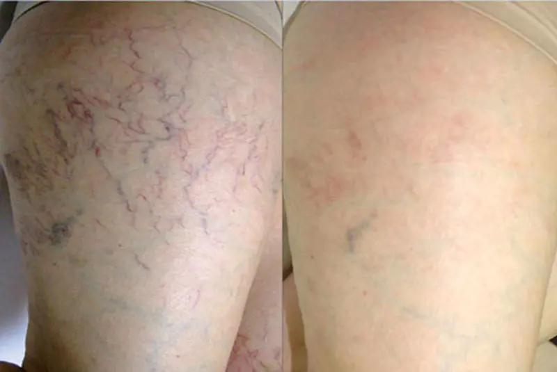 عکس قبل و بعد درمان رگهای عنکبوتی